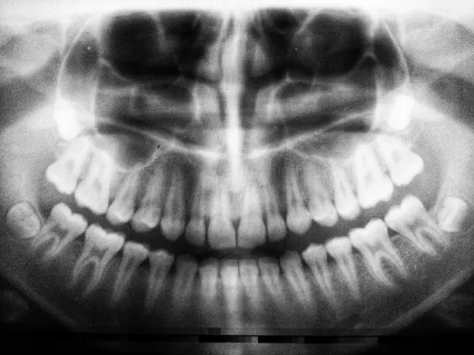 opg x ray